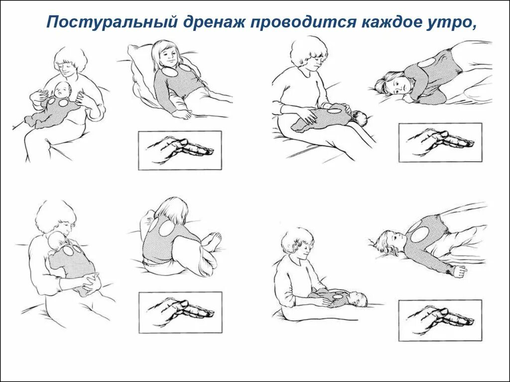 Дренажные положения при муковисцидозе. Постуральный дренаж. Положении для постурального дренажа. Положения при постуральном дренаже. Постуральный массаж