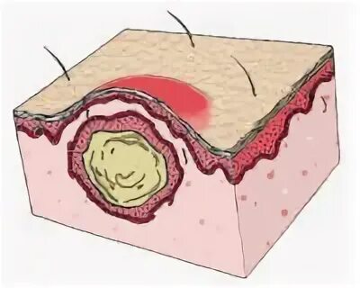 Воспаление ткани латынь. Патологическая полость. Рожевое воспаление тканей. Кожа: стенка кисты с грануляциями. Ткань воспаление волдыр.