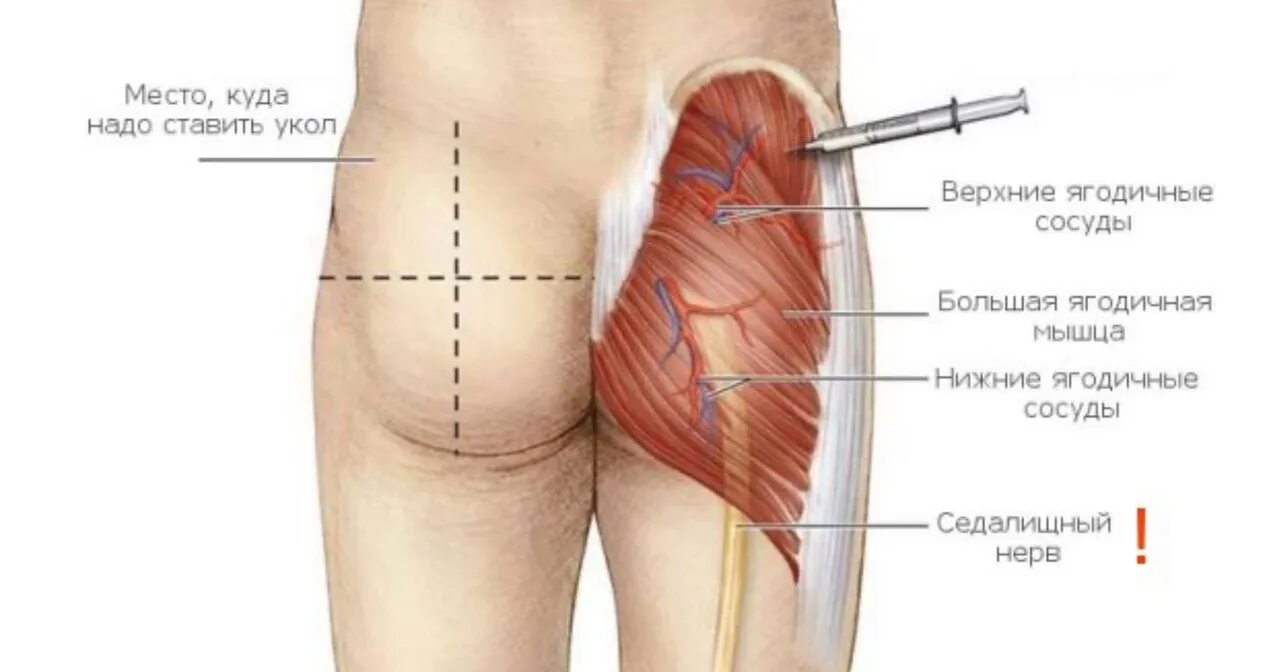Колоть уколы места. Как сделать правильный укол в ягодицу. Как правильно делать укол в ягодицу. Схема как правильно колоть уколы в ягодицу. Как правильно сделать укол в мышцу ягодицы.