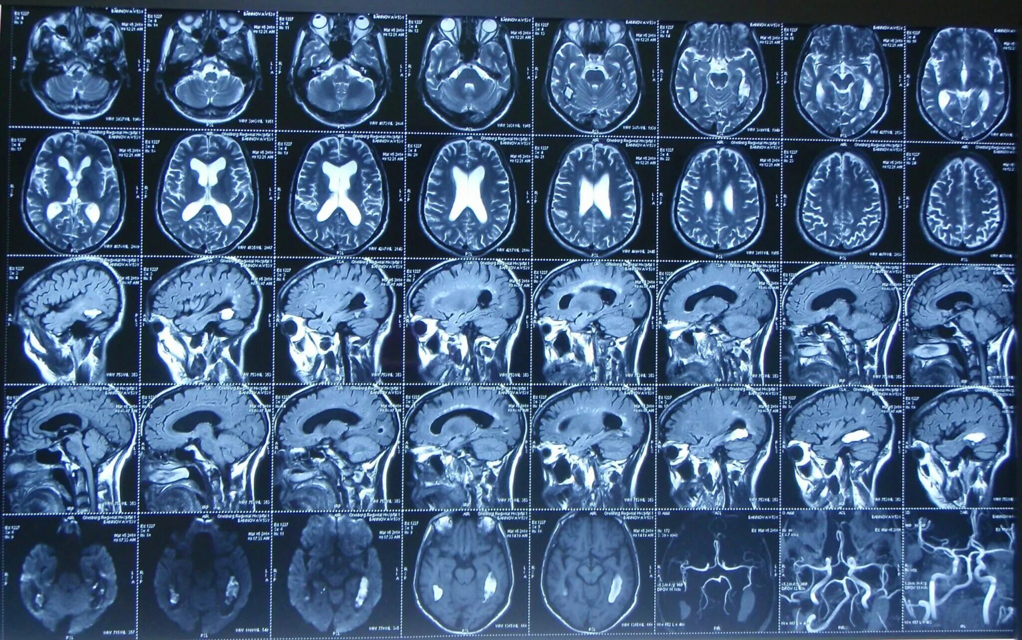 Патологии на мрт. Кт томограмма головного мозга. Компьютерная томография кт головного мозга. Магнитно-резонансная томография мрт снимки. Магнитно резонансные томограммы головного мозга.