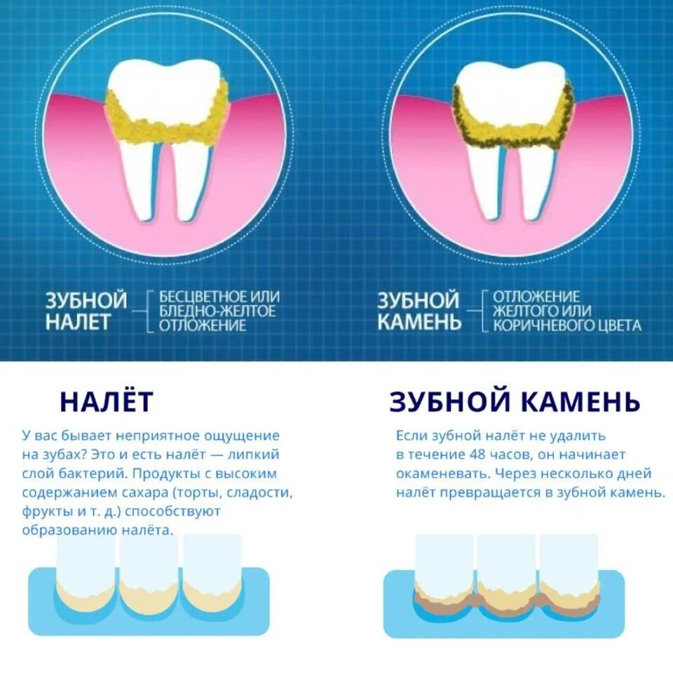 Как отличить зубы. Зубной налет и камень. Наддесневые и поддесневые зубные отложения.. Зубной камень у основания зуба. Как определить поддесневой зубной камень. Причины образования зубного камня.