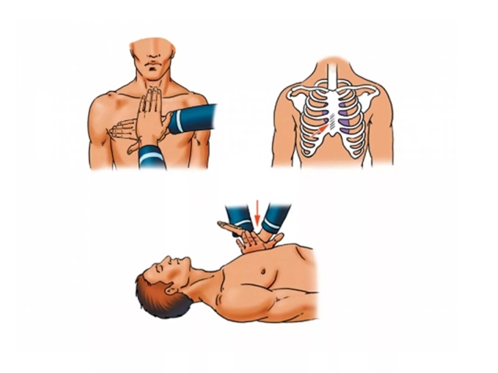 Техника проведения непрямого массажа сердца. Непрямой массаж сердца техника выполнения. Непрямой массаж сердца проводится ладонью. Компрессии грудной клетки (непрямой массаж сердца). Сжатие груди