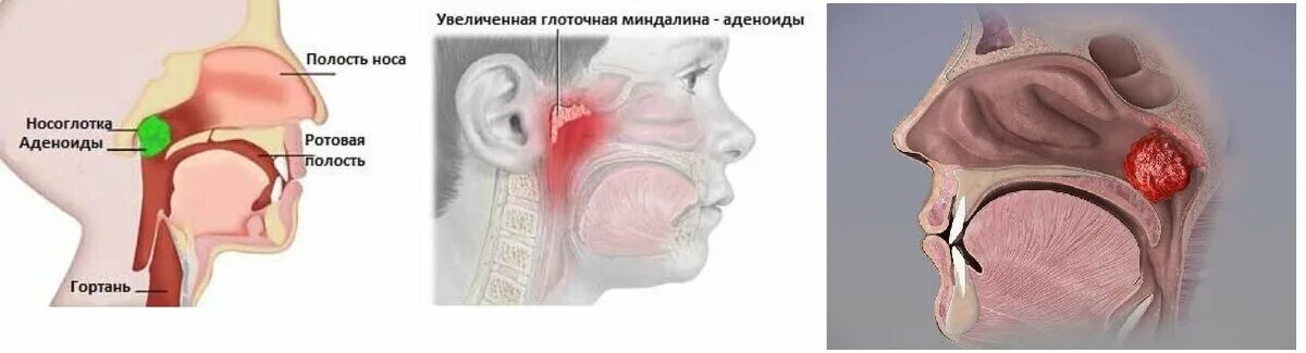 Болит носоглотка что делать. Анатомия ЛОР органов аденоиды. Глоточная миндалина аденоиды. Носоглотка воспаление аденоиды. Гиперпластический ринит аденоиды.