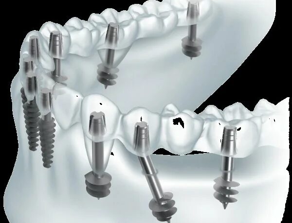 импланты в оренбурге сколько стоят