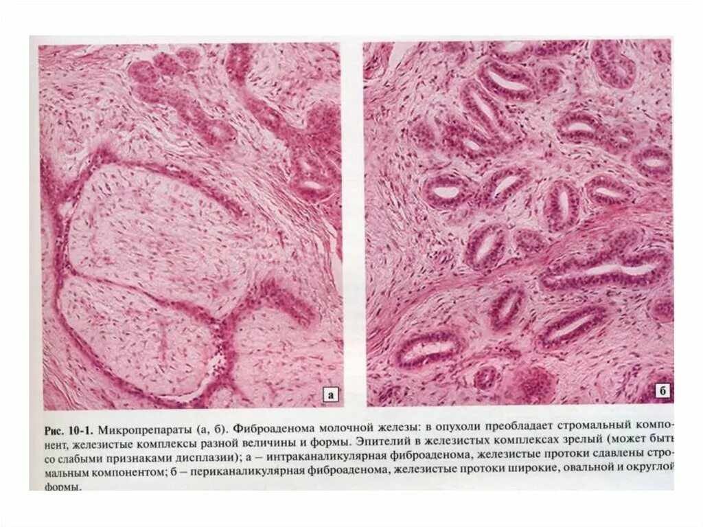 Железистая гиперплазия предстательной железы. Фиброаденома молочной железы гистология. Фиброаденома молочной железы микропрепарат. Гиперплазия предстательной железы микропрепарат. Фиброаденома молочной железы гистология препарат.