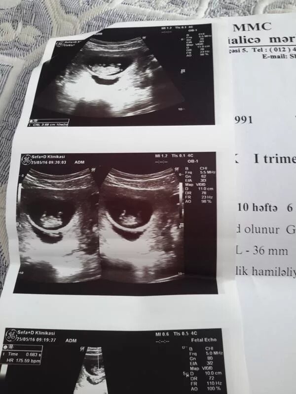 Снимок УЗИ 10 недель. УЗИ 10-11 недель беременности.