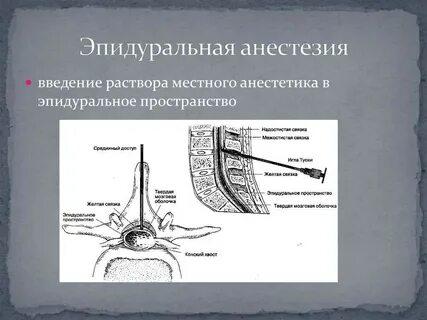 Эпидуральное обезболивание