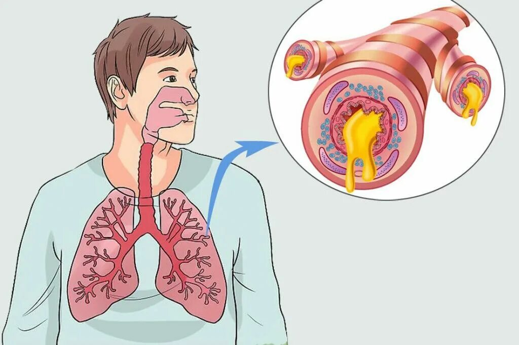Гнойно обструктивный бронхит. Острый и хронический бронхит. Симптомы поражения бронхов. Сильный кашель без остановки