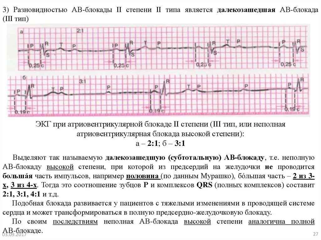 Блокада инструкция. АВ блокада 3 степени описание ЭКГ. АВ блокада 2 степени описание ЭКГ. ЭКГ при АВ блокаде 2 степени. Описание ЭКГ при АВ блокаде 1 степени.