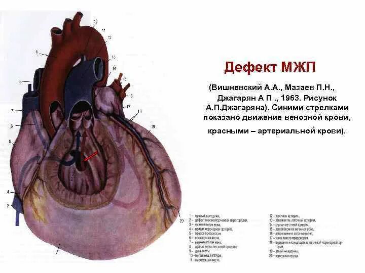 У какого животного имеется неполная межжелудочковая перегородка. Межжелудочковая перегородка сердца. анатомия межжелудочковой перегородки сердца. мембранозная часть межжелудочковой перегородки. строение межжелудочковой перегородки.