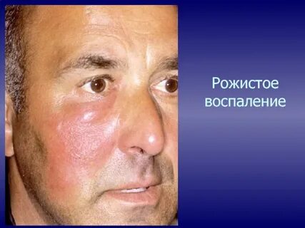 Рожа симптомы болезни лечение