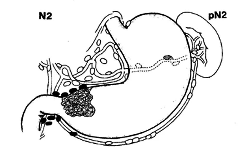 Опухоль желудка метастазирование. Метастазы желудка по авторам. Метастазирование в лимфатические узлы. Лимфатические узлы желудка метастазы. Онкология желудка 4 стадия