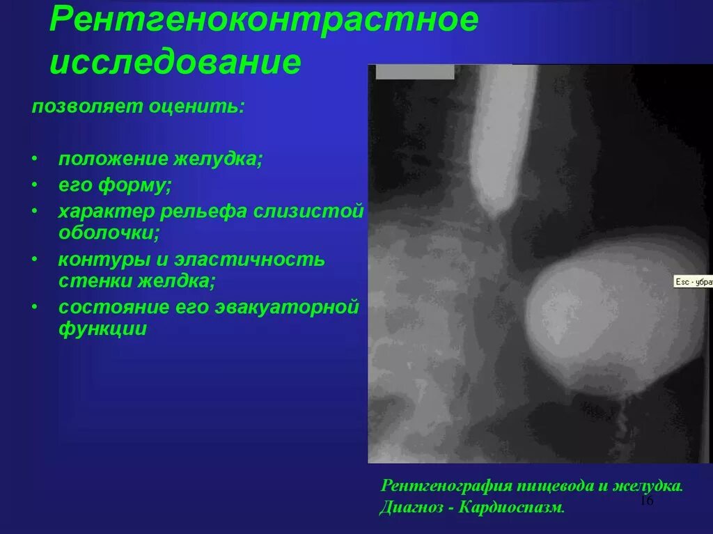 Рентгенологическое обследование желудка. Рентгенологическое обследование желудка. Контрастные рентгенологические исследования желудка. Рентгенологические методы исследования органов пищеварения. Рентгеноконтрастные методики в исследовании жкт.