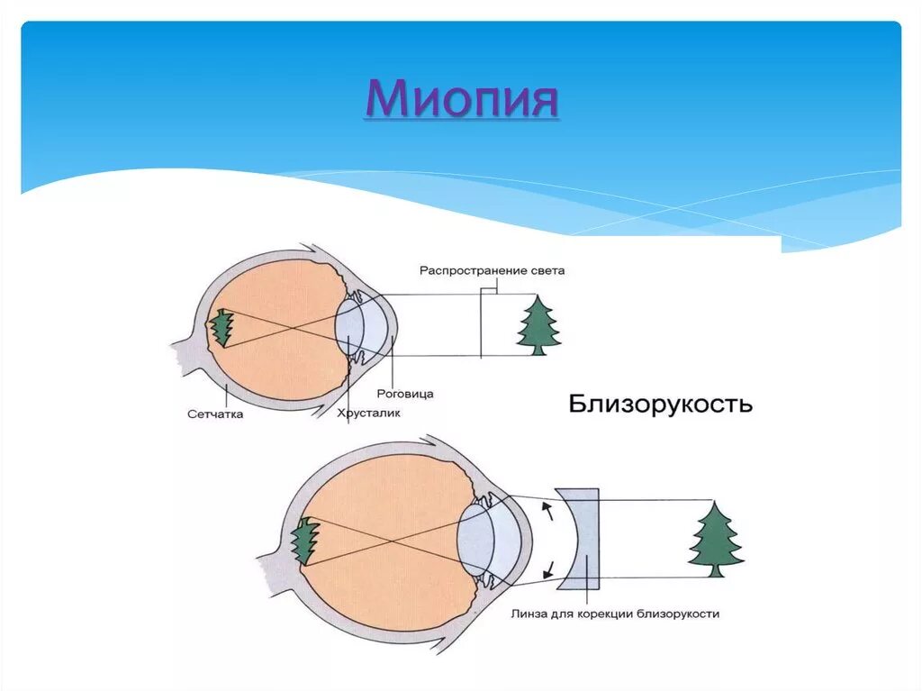 Близорукость миопия. Заболевания глаз близорукость. Мтопи. Миопия что это простыми словами