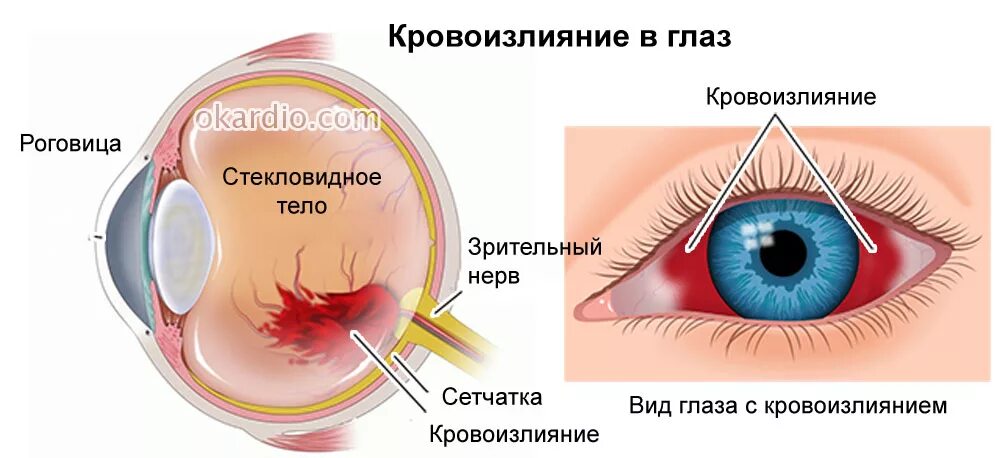 Укороченное глазное яблоко