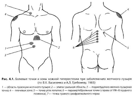 Желчный куда отдает боль. Локализация боли при холецистите. Симптомы острогог холестетит. Желчная колика симптомы симптомы. Острый холецистит иррадиация болей.