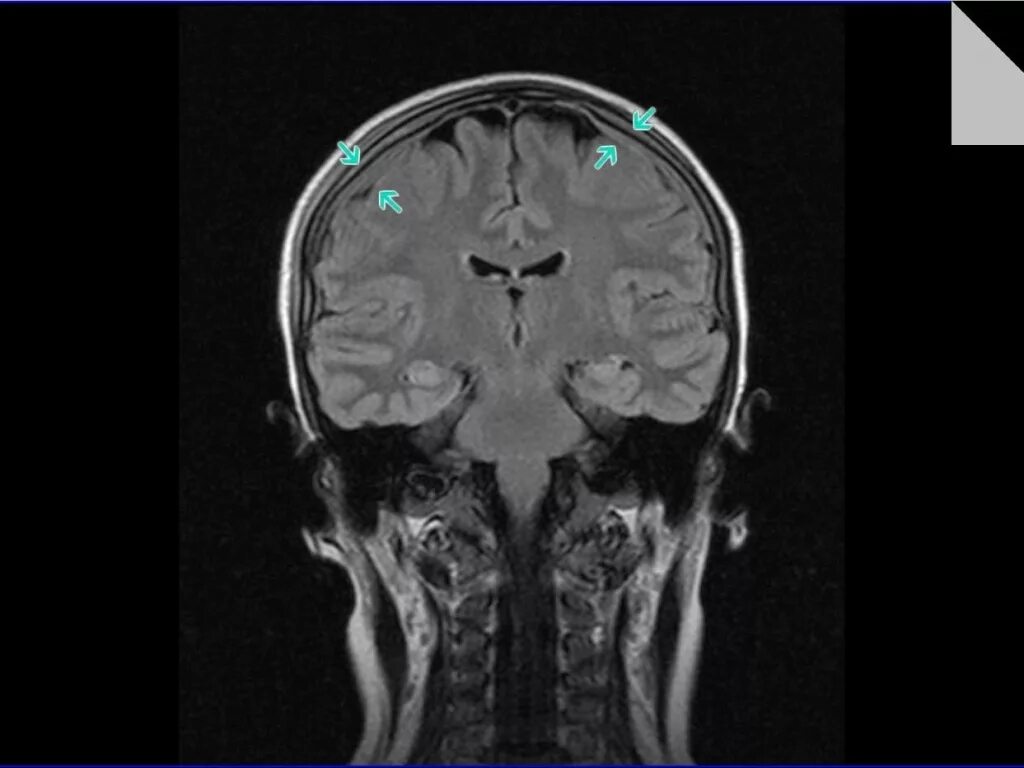 Партизана железняка 26 мрт эксперт. Аппарат мрт головы. 3 тесла аппарат мрт. Утолщение мозговых оболочек на мрт. Мрт головы курган.