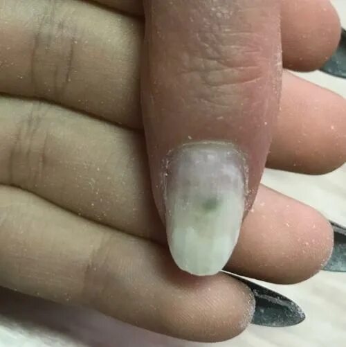 Синкгеойная псивдомания. Пятно под гель лаком. Лейконихия продольная. Ониходистрофия - онихолизис. Пятно под гель лаком.