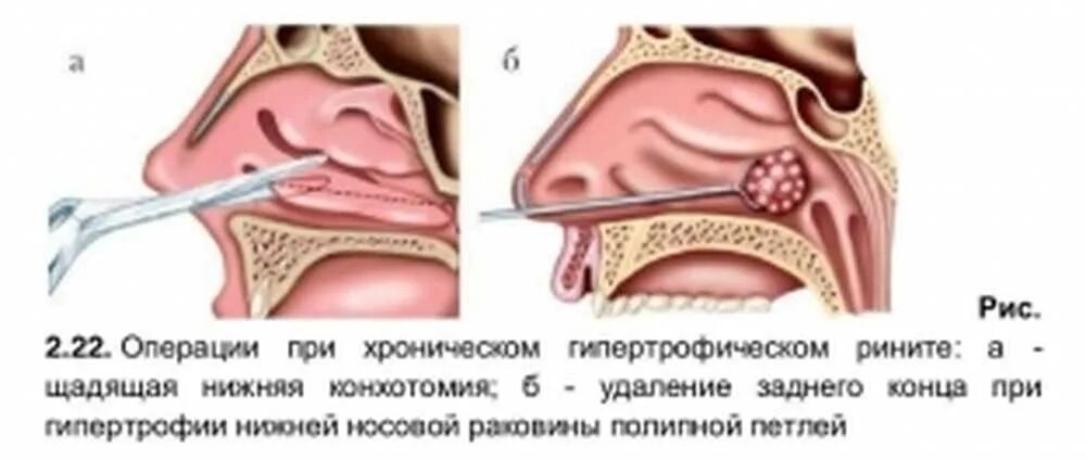 Операция при насморке