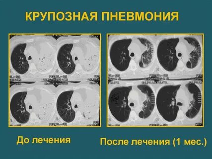 Бактериальная двусторонняя пневмония