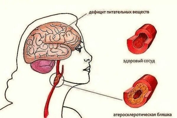Атеросклероз головного мозга лечение у женщин. Диета при атеросклерозе сосудов шеи. атеросклероз сосудов мозга питание. питание при атеросклерозе сонной артерии. еда при атеросклерозе сосудов шеи.