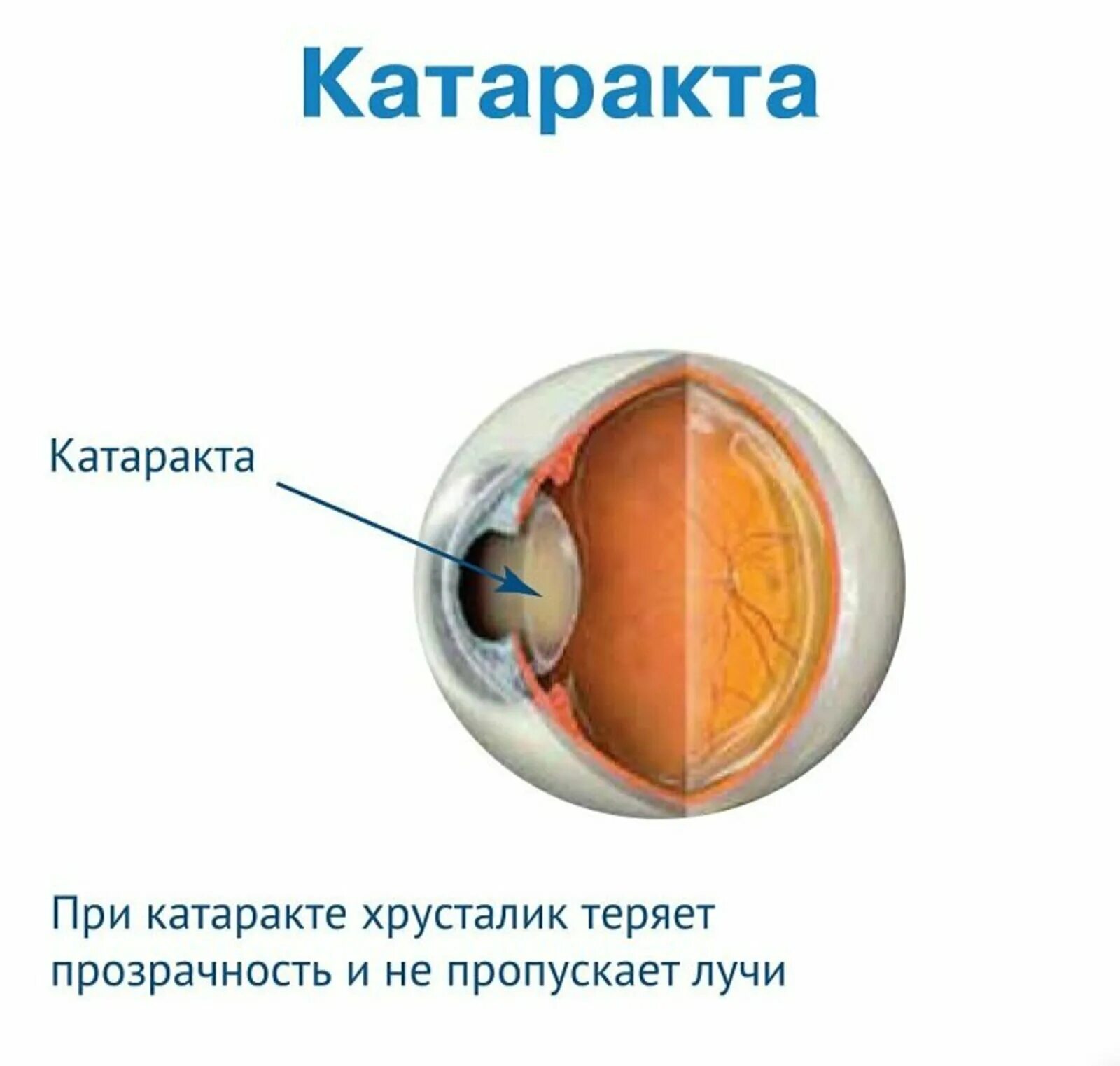 Катаракта хрусталик строение. Катаракта – помутнение хрусталика глаза.. Катаракта схема глаза. Атафракта.