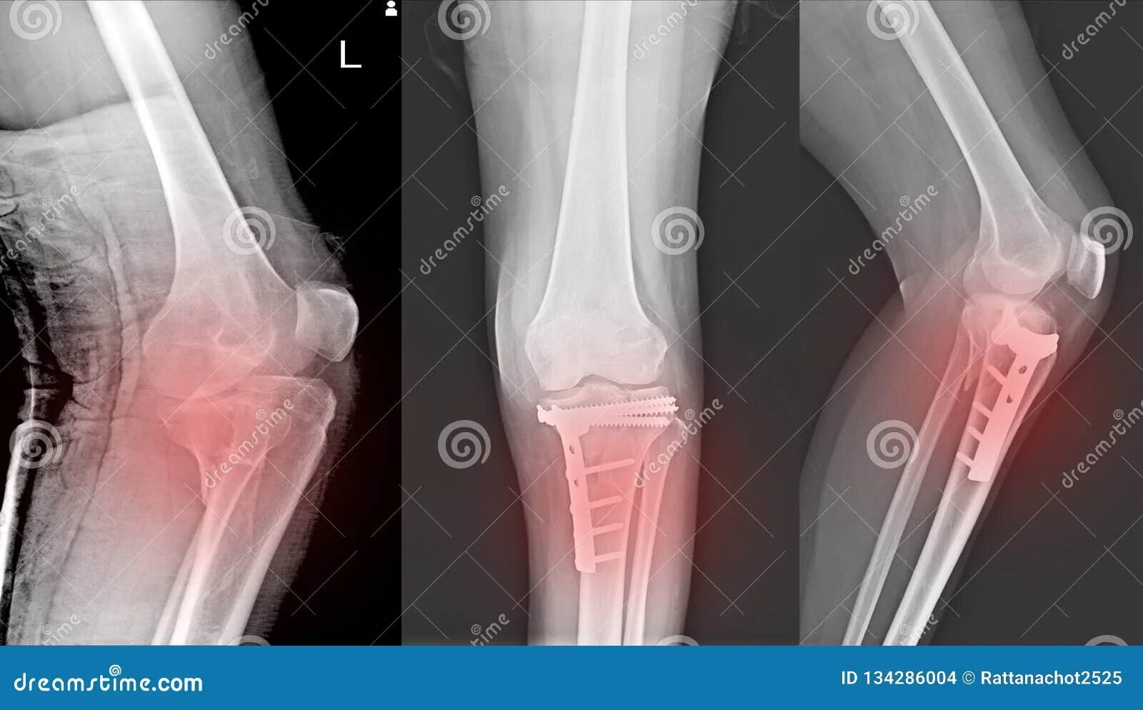 Перелом надколенника рентген. Перелом надколенника остеосинтез. Перелом коленной чашечки рентген. Коленный сустав перелом берцовая кость.