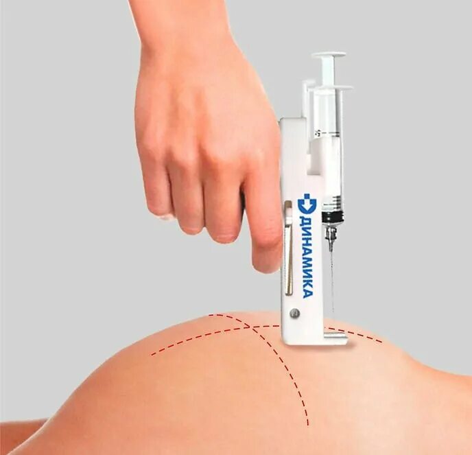 как делается укол внутримышечно. схема инъекций витаминов группы в. внутримышечная инъекция. колоть в1. комплекс витаминов б1 б6 б12 в ампулах.