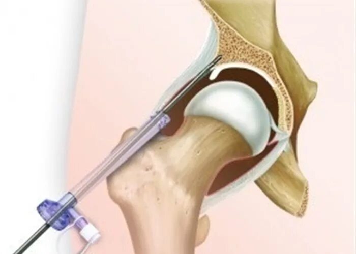 Операция артроскопия коленного сустава. Артроскопическая терапия коксартроза. Пункция тазобедренного сустава. Артроз операция тазобедренного сустава