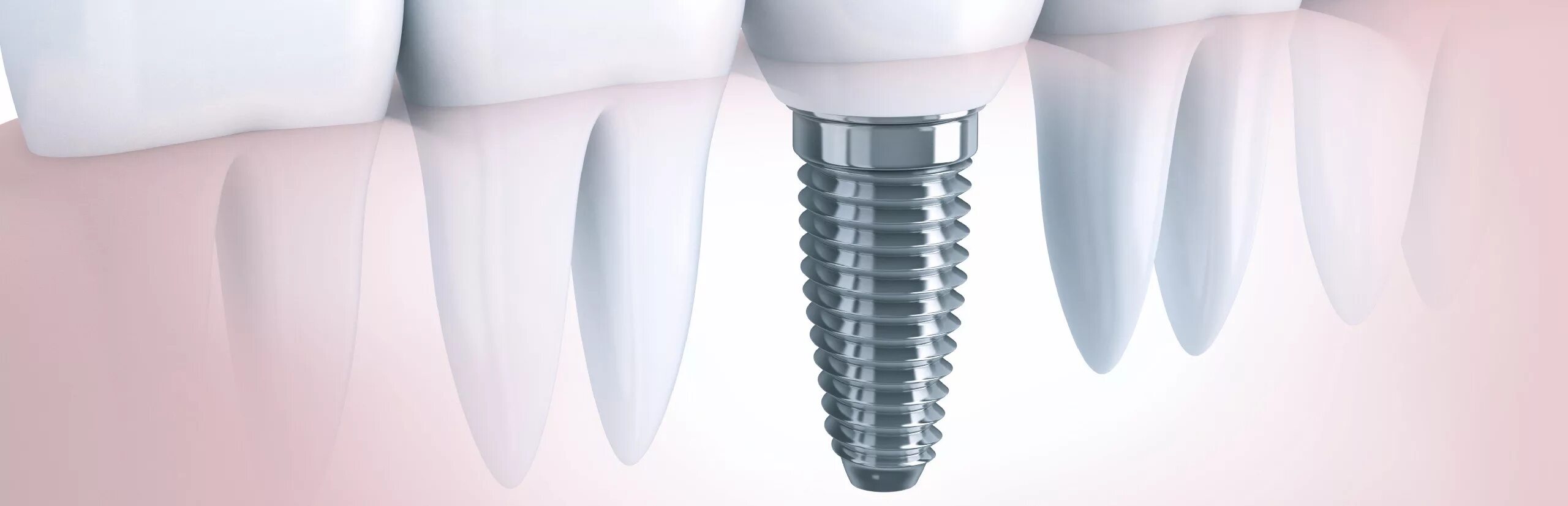 Срок импланта. Имплантация dentium. dentium импланты. дентальные имплантаты dentium. имплантаты дентис ds2fw4814s.