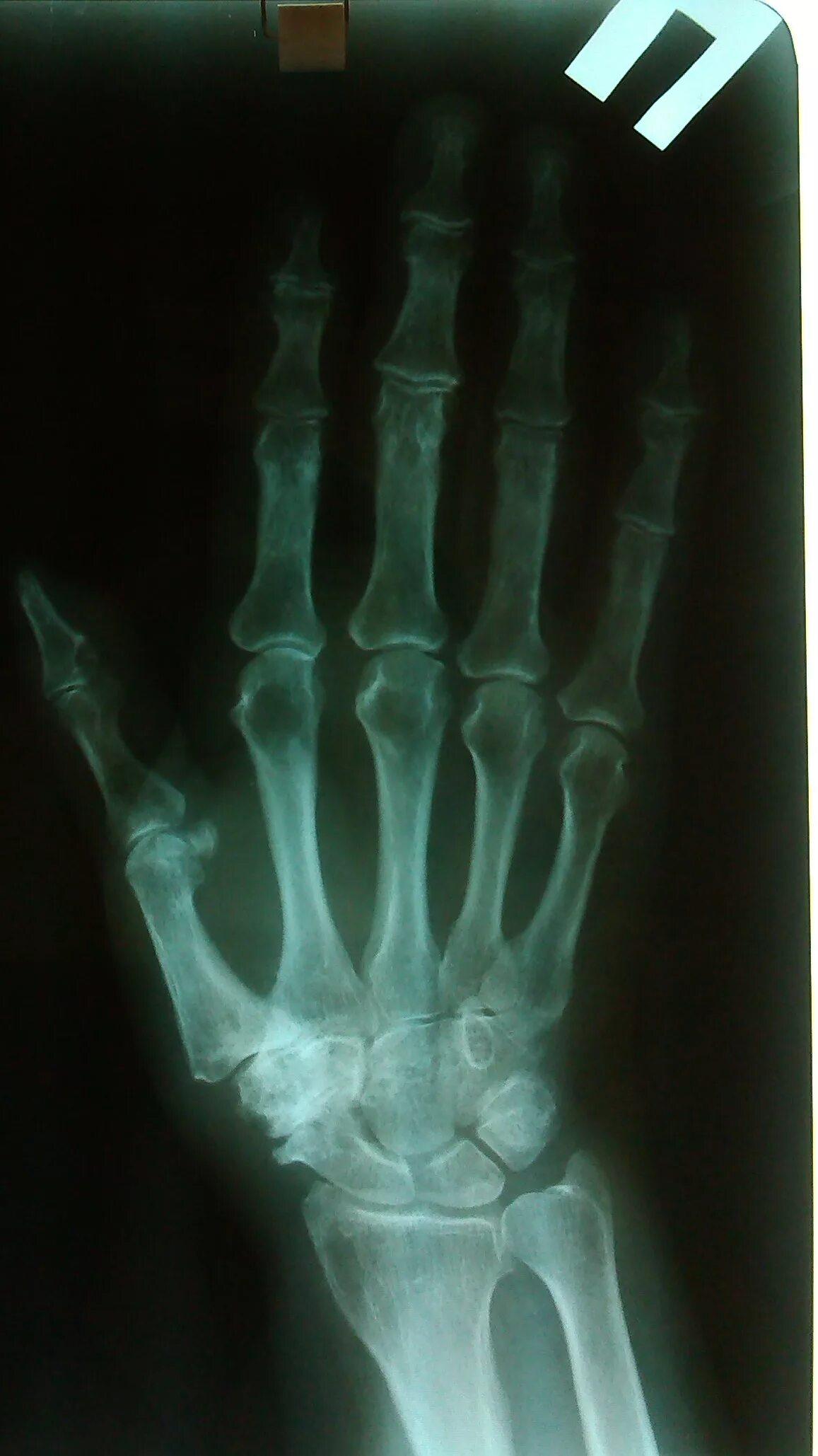 Трещина фаланги. Краевой перелом проксимальной фаланги. Перелом проксимальной фаланги 1 пальца. Краевой перелом проксимальной фаланги 5 пальца. Перелом основания проксимальной фаланги 5 пальца.