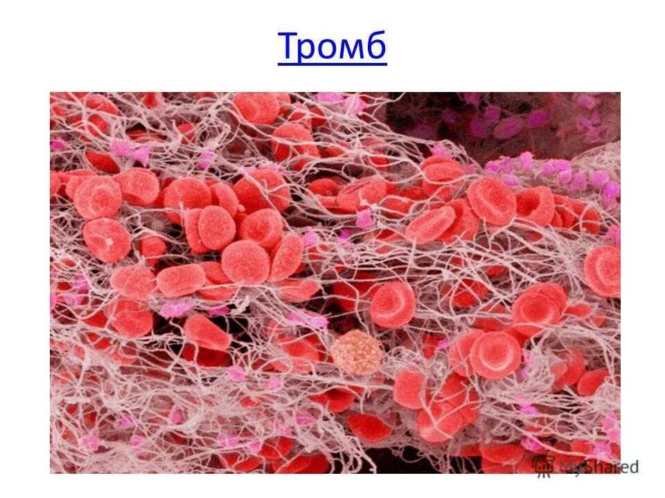 Сколько стоит тромба. Тромб свертывание крови. Фибриновый тромб гистология. Свертываемость крови тромб. Свёртываемость крови фибрин.