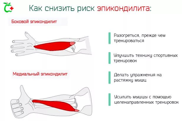 Эпикондилит симптомы локтевого