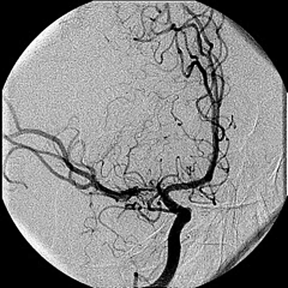 Венография головного мозга. Церебральная ангиография сосудов головного мозга. Селективная церебральная ангиография. Селективная церебральная ангиография сосудов головного мозга. Кт ангиография инсульт.