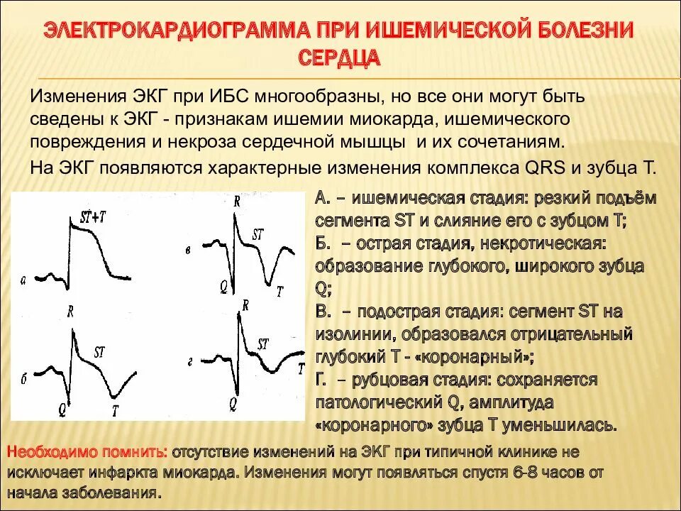 Миокард программа. Изменения на экг при ишемической болезни сердца. признаки ишемии миокарда на экг. критерии ишемии миокарда на экг. изменения на экг при ишемии миокарда.