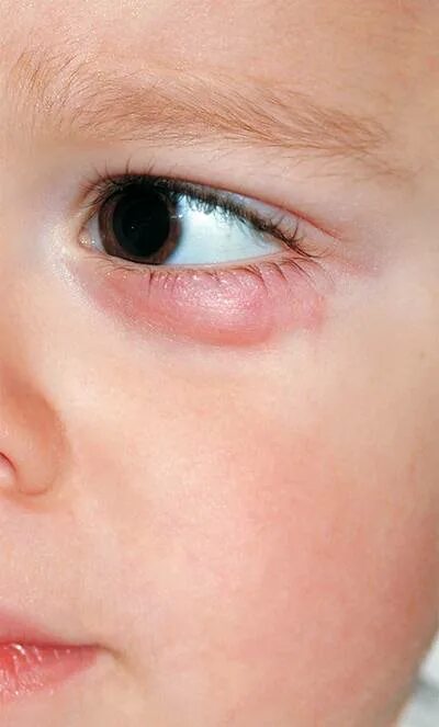 Как вылечить ячмень у ребенка на глазу. Ячмень под глазом у ребенка. ЯСЬМЕНЬ под глазом у ребенка.
