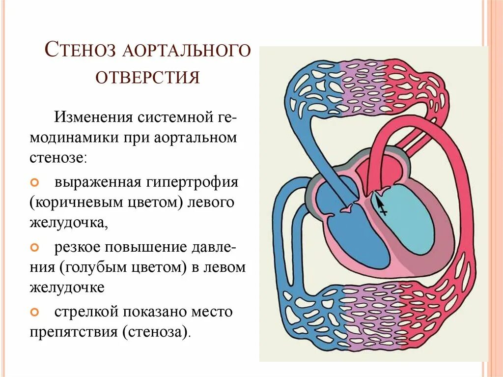 Стеноз аортального отверстия