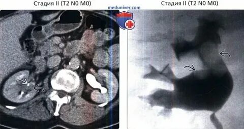 Злокачественное новообразование лоханок почки
