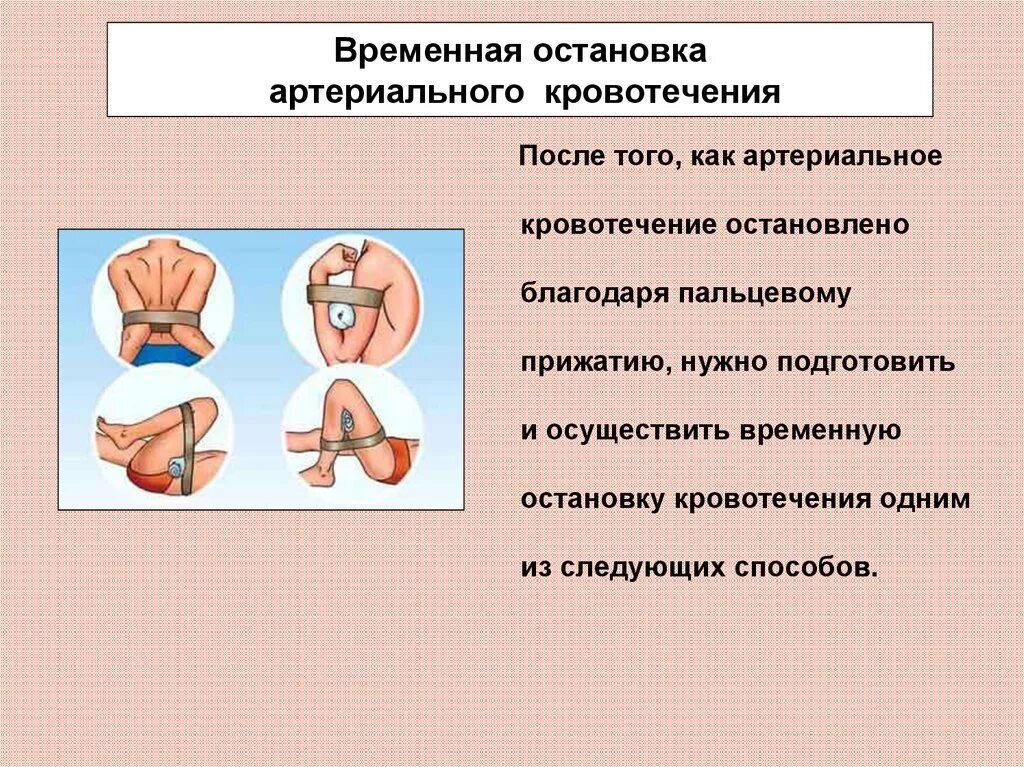 Какой способ артериального кровотечения наиболее эффективен. Остановка артериального кровотечения. Для временной остановки артериального кровотечения. Временные способы остановки артериального кровотечения. Способы Остановить артериальное кровотечение.