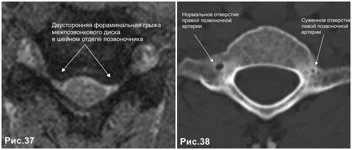 Каудальная миграция грыжи диска. Дорзальная парамедианная грыжа. фораминальная грыжа диска кт. фораминальная грыжа межпозвоночного диска. дорзальная грыжа мрт.