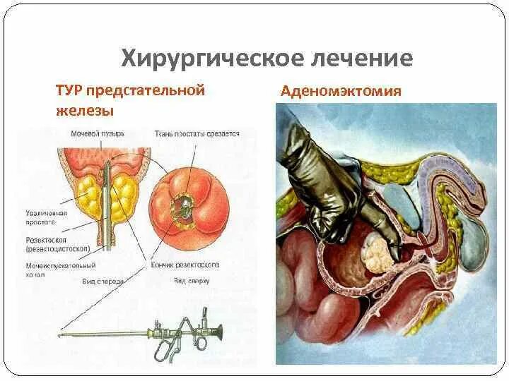 Тур предстательной железы. Операция предстательной железы. Трансуретральная резекция простаты. Трансуретральная резекция аденомы предстательной железы. Гиперплазия предстательной железы операция