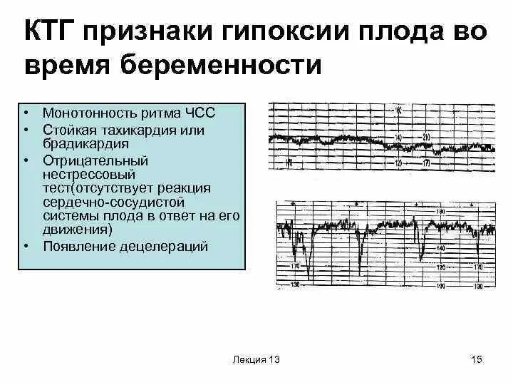 Как определить сердцебиение ребенка. КТГ при беременности при гипоксии плода. Кардиотокография при гипоксии плода. КТГ гипоксия плода 34 недели беременности. КТГ при беременности начальные признаки гипоксии плода.