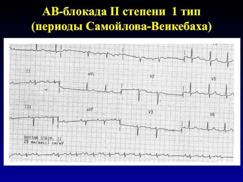 Период венкебаха на экг. Экг ав-блокада ii степени мобитц 2. Период венкебаха на экг. Блокада 2 степени мобитц 1 на экг. Период венкебаха на экг.