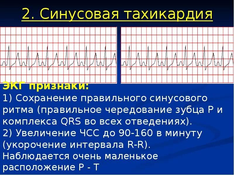 Синусовая тахикардия вертикальное. Синусовая тахикардия ЭКГ признаки. Синус тахикардия. Ритм синусовая тахикардия. ЭКГ при синусовой тахикардии.