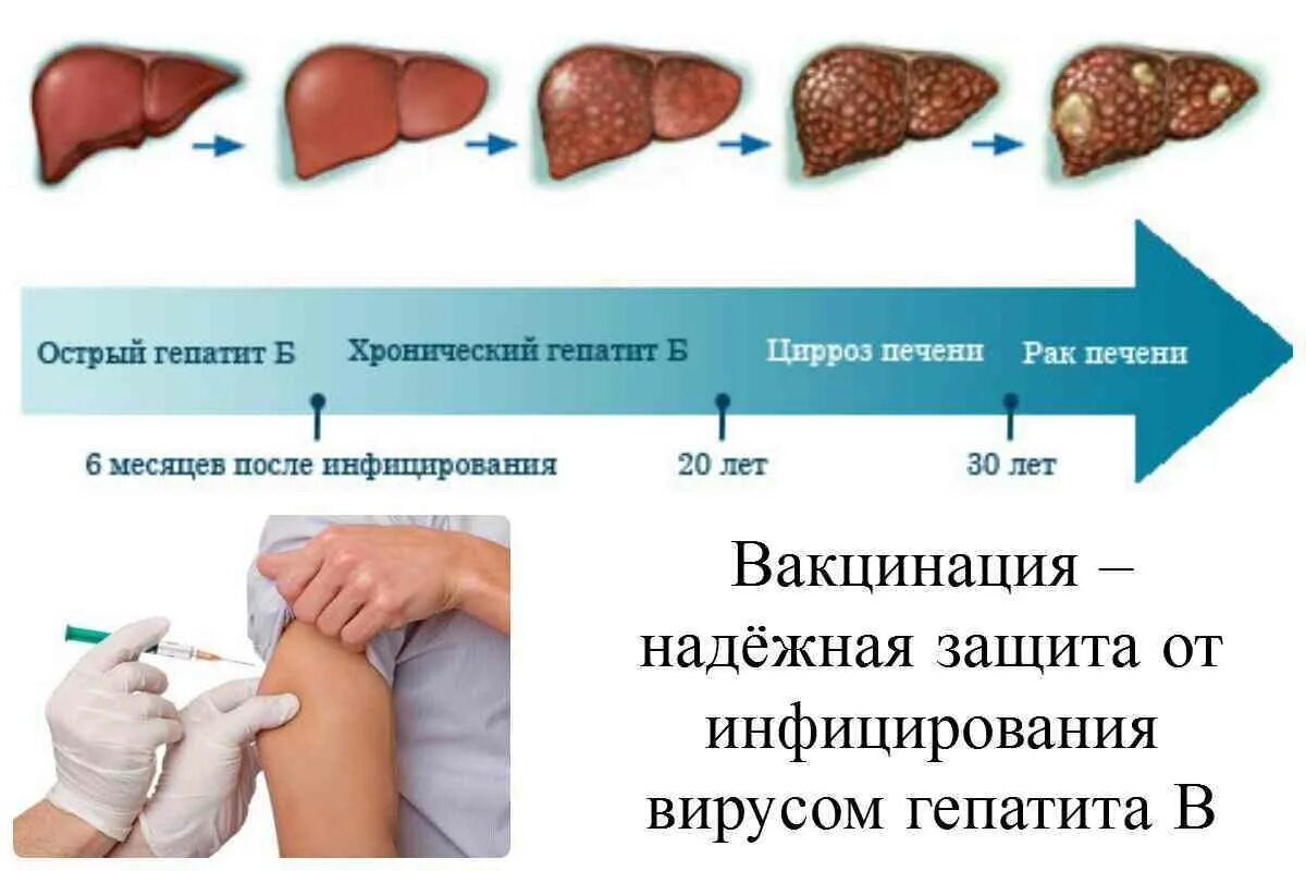 Гепатит на сколько лет. Печень при вирусном гепатите. Вирусный гепатит симптомы.