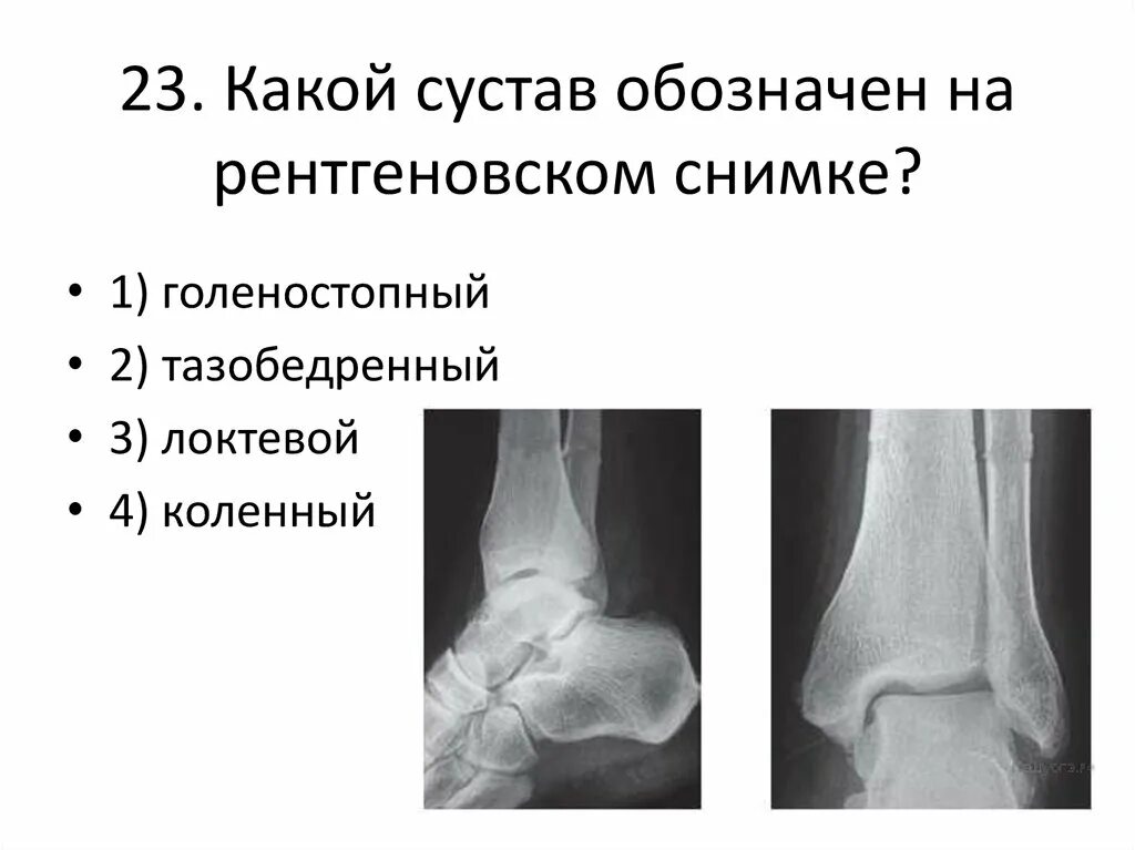 Какой сустав изображен. Сустав на снимке. Рентгенограмма локтевого сустава. Какой сустав обозначен на рентгеновском снимке. Какой сустав обозначен на рентгеновском снимке 1.