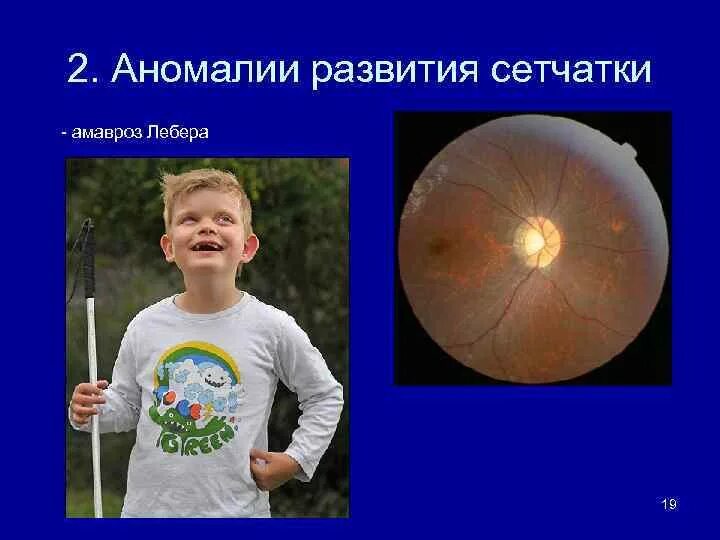 Наследственная оптическая нейропатия Лебера. Атрофия зрительного нерва Лебера. Врожденный амавроз Лебера.
