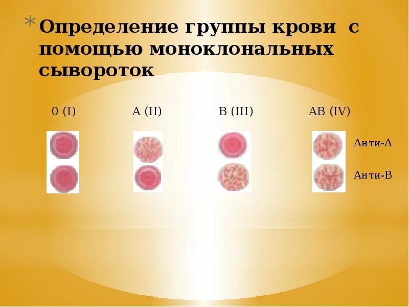 Определение группы крови. Методика определения группы крови. Определение группы крови с помощью моноклональных. Группы крови хирургия. Группа крови в роддоме