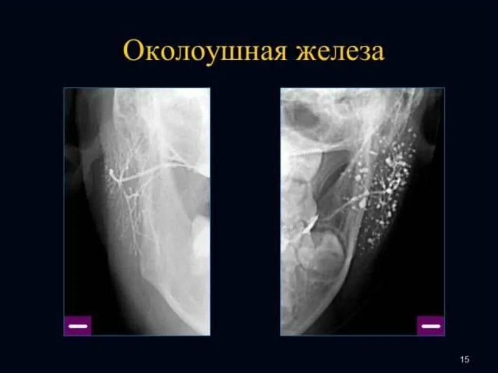 Камень протока слюнной железы УЗИ. Слюнные железы обызвествление рентген. Камень слюнной железы УЗИ. УЗИ околоушной слюнной железы. Узи околоушных желез