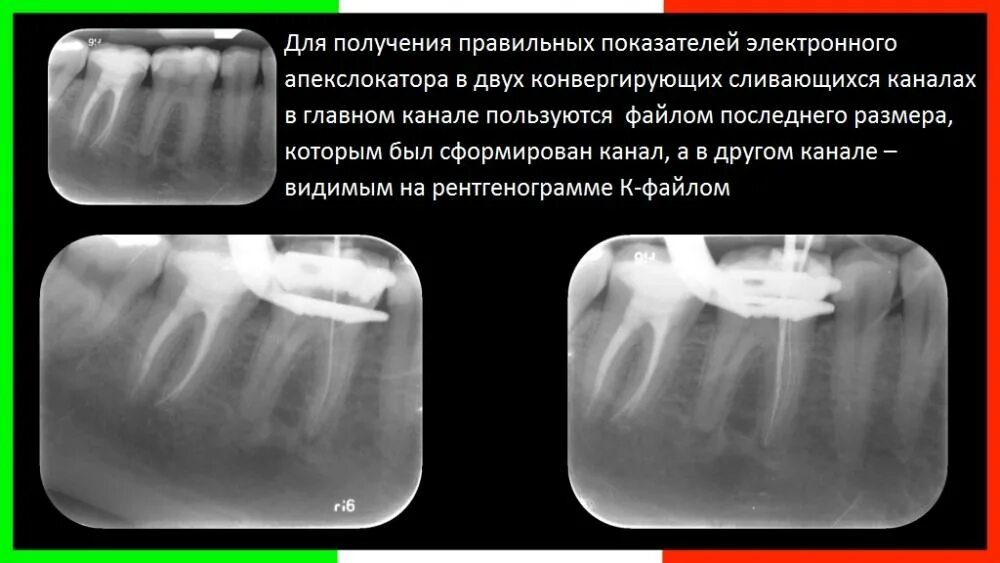 Определение рабочей длины корневого канала. Рабочая длина корневого канала. тактильное определение длины корневого канала. понятие рабочая длина корневого канала. длина корневых каналов 36 зуба.